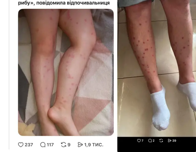 дописи із фотографіями ніг, обсипаних червоними плямами чи прищами