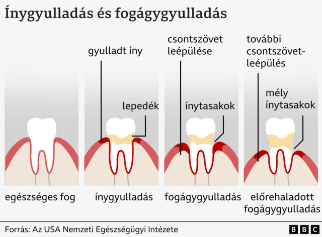 Egy egészséges fogtól az előrehaladott fogágygyulladásig egy ábra arról hogy mi történik a fogakkal, az ínnyel, a fogággyal és a csontszövettel 