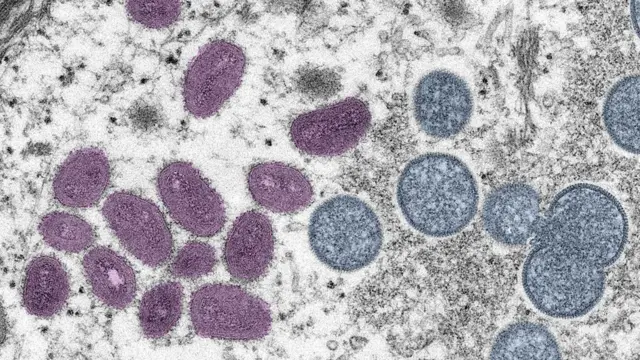 Image de microscopie électronique (ME) colorisée numériquement représentant un virion (particule virale) de la variole du singe.