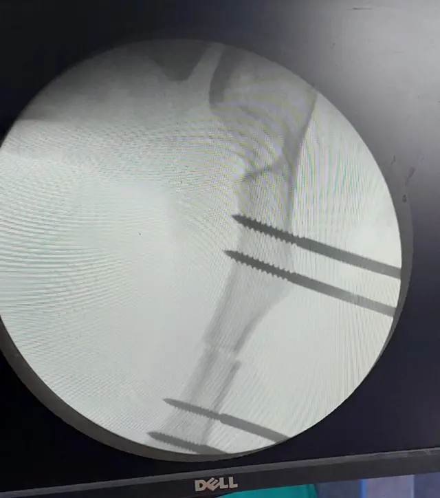 எலும்பை உடைக்கும்போது எடுக்கப்பட்ட எக்ஸ்ரே 