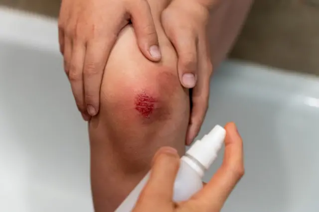 La rodilla raspada de un niño y la mano de una mujer desinfectándola.