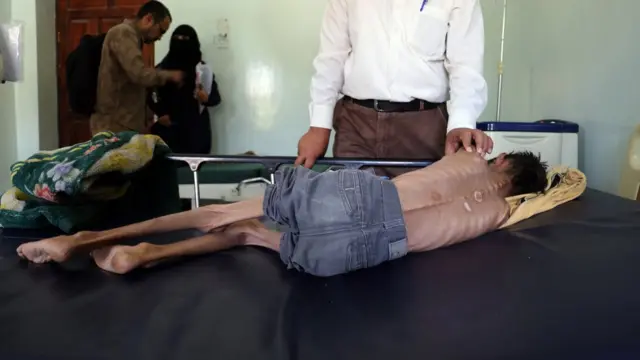 طفل يمني يعاني من سوء التغذية