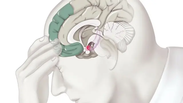 Illustration des zones du cerveau impliquées dans le processus de dépression.