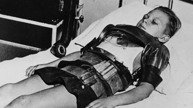 Поліомієліт