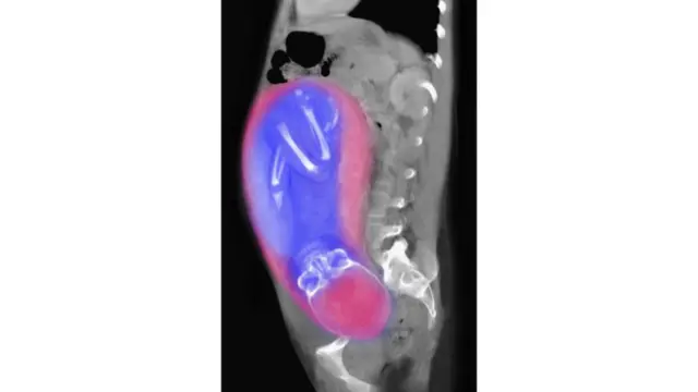 CT scan yang menunjukkan fetus yang siap dilahirkan