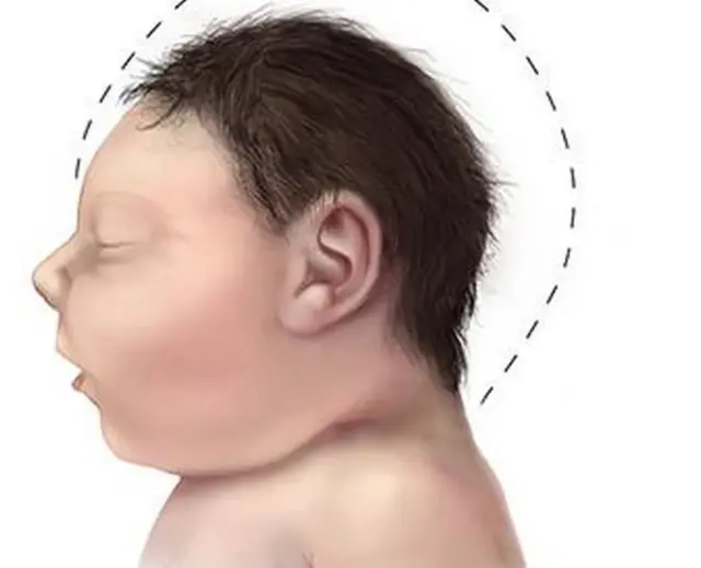 Nwa nwere 'microcephaly