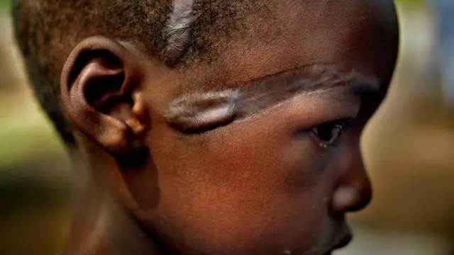 نشبت صراعات عديدة على مر العصور دون استخدام الأسلحة النارية، ويظهر في الصورة لاجئ من قبيلة الهوتو جُرح جرحا غائرا بمنجل في خضم المذابح التي ارتكبت في رواندا عام 1994