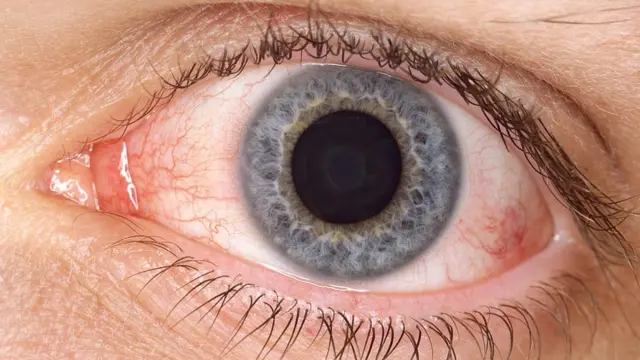 কনজাংকটিভাইটিসে আক্রান্ত চোখ।