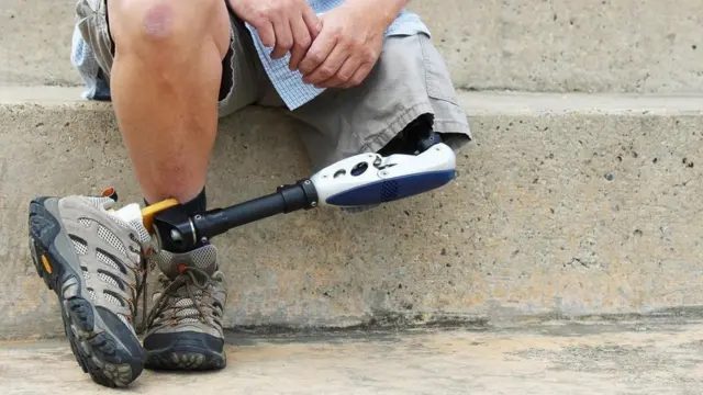 رجل يرتدي أحد الأطراف الصناعية