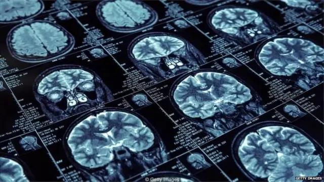 ਦਿਮਾਗ ਦੇ ਸਕੈਨ