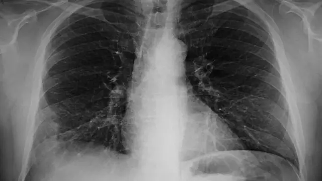 Ngụgụ onye nwere ọrịa 'Pneumonia' dịka foto 'X-ray' si gosi.