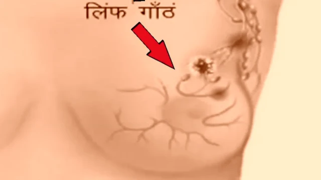 स्तन कैंसर