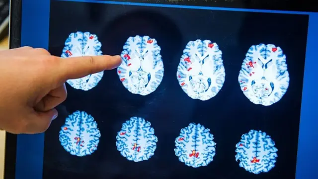 a brain scan showing the brain activity