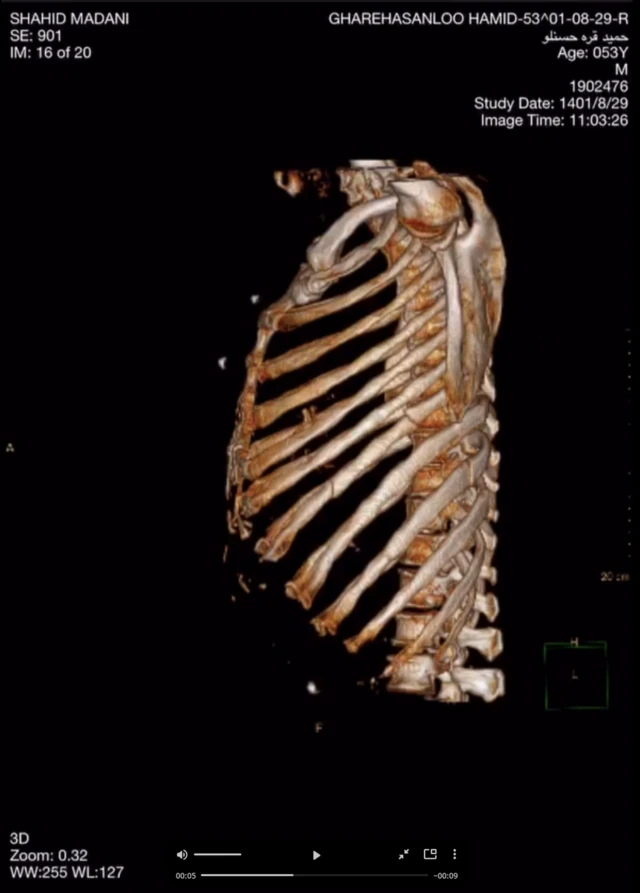 عکسی که به دست بی بی سی فارسی رسیده و در آن شکستگی دنده دیده می‌شود