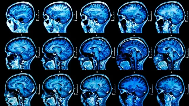 Периоды стресса могут активизировать вирус герпеса, и это порой имеет далеко идущие последствия для мозга человека