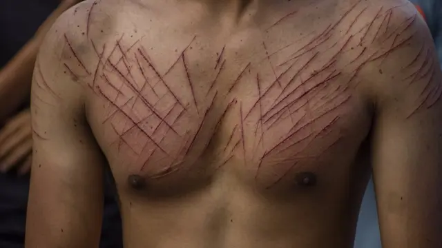 Image contains graphic content.) Scalpal marks on the chest of a Kashmiri Shiite Muslim are visible after he flagellated himself during an Ashura procession on August 30, 2020, in Budgam, west of Srinagar, the summer capital of Indian administered Kashmir, India. Indian authorities deployed its government forces in Kashmir to impose strict restrictions in various parts of the region to bar Shiite mourners from carrying out any Ashura processions which marks the death of Prophet Muhammad's grandson the revered Imam Hussein in Karbala, Iraq in 680 AD. Shiite Muslims mourn by flagellating themselves with knives and swords. The restrictions have been imposed in all districts of the Valley in the wake of the COVID-19 pandemic.