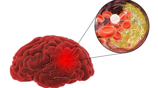 Illustration d'un cerveau subissant un accident vasculaire dû à l'athérosclérose.