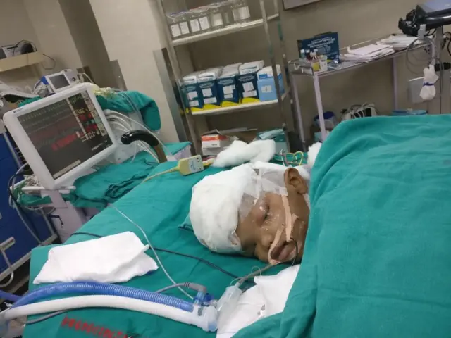 सिर से जुड़वां बच्चे