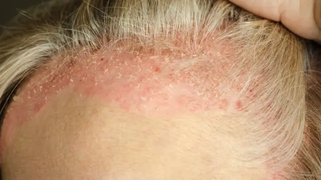 psoríase na pele e couro cabeludo