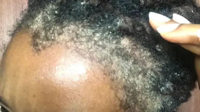 Scalp psoriasis