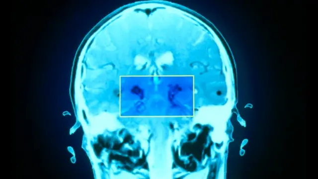 Усталость может возникать из-за повреждения базальных ядер. На фото изображен мозг пациента с болезнью Паркинсона