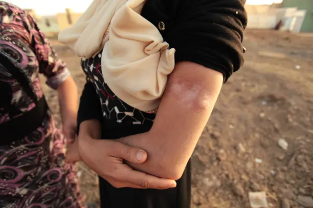 Шрам на руке у Лайлы