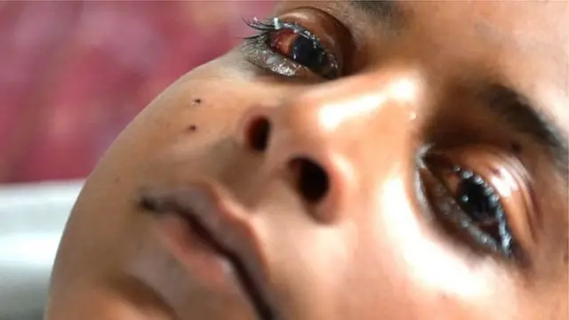 पैलट से ज़ख्मी बच्चा