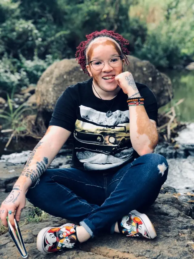 Njee Wangoi anaishi na hali ya vitiligo
