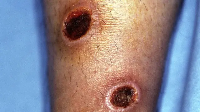 پشاور، بڈھ بیر، ٹیلہ بند، لیشمینیاسس، نصیر اللہ خان بابر ہسپتال، ایم ایس ایف