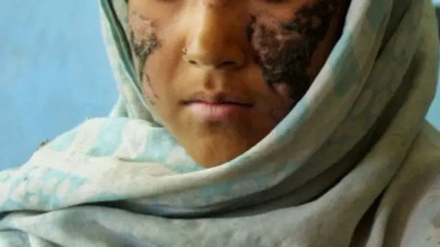 رسمي شمېرې ښيي چې په لشمانیا ۱۴ زره اخته کسان په کابل کې ثبت شوي او ۲۴ زره نور په ځینو نورو ولایونو کې پر دغې ناروغۍ اخته شوي دي.