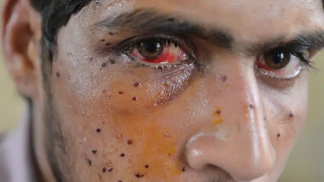 இந்திய ராணுவத்தால் வீசப்பட்ட பெல்ட் குண்டுகளால் தாக்கப்பட்ட காஷ்மீர்வாசி