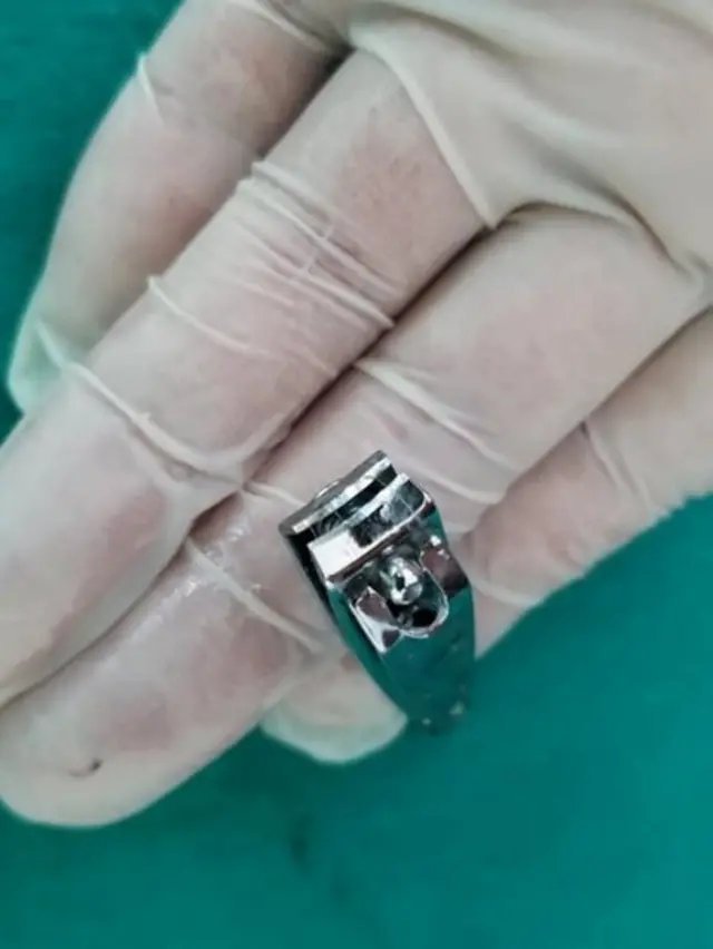 Grickalica za nokte koju je Teljaku izvadio iz stomaka pacijenta