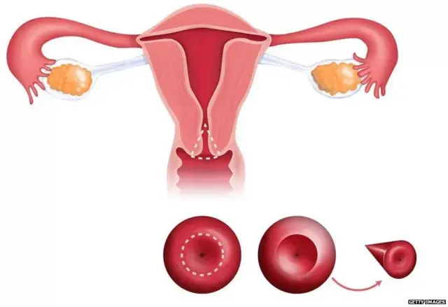 ਆਮ ਤੌਰ 'ਤੇ 45 ਤੋਂ 70 ਸਾਲ ਦੀਆਂ ਉਮਰ ਦੀਆਂ ਔਰਤਾਂ 'ਚ ਬੱਚੇਦਾਨੀ ਦੇ ਮੂੰਹ ਦੇ ਕੈਂਸਰ ਦੇ ਹੋਣ ਦਾ ਖ਼ਤਰਾ ਬਣਿਆ ਰਹਿੰਦਾ ਹੈ