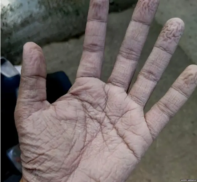 ਅਸੀਮ ਗਰਗਵਾ ਨੇ ਆਪਣੇ ਹੱਥਾਂ ਦੀ ਇਹ ਤਸਵੀਰ ਸੋਸ਼ਲ ਮੀਡੀਆ ਉੱਤੇ ਪੋਸਟ ਕੀਤੀ