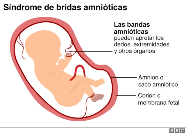 Gráfico ilustrando el síndrome de bridas amnióticas