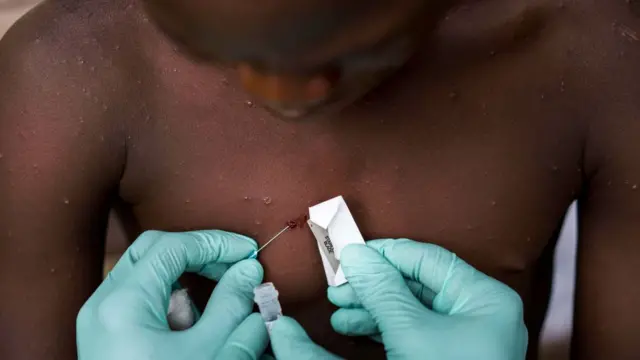 cacar monyet, kesehatan