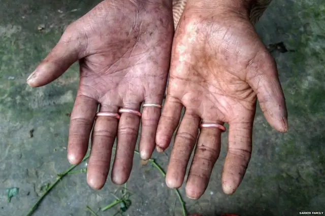 फिंगरप्रिंट, आजार