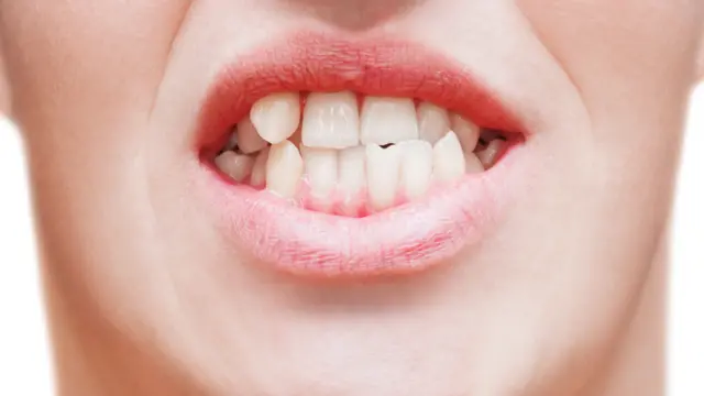 Hombre con dientes torcidos.