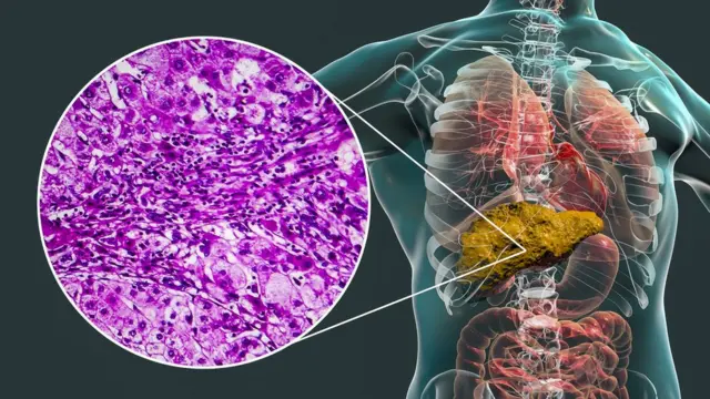 Gráficosite de aposta afunum fígado com cirrose