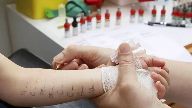 Brazo de un niño al que se realiza un test de alergias