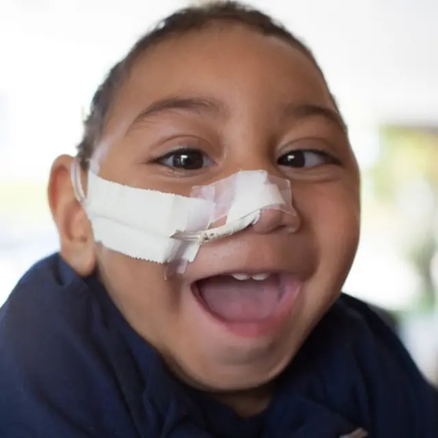 José Wesley, afectado por el virus del Zica, a los 16 meses de edad