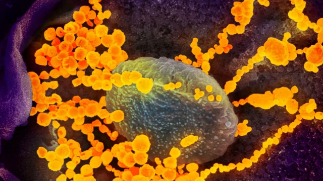 A scanning electron microscope image of SARS-CoV-2 (the round gold objects) emerging from the surface of cells cultured in the lab