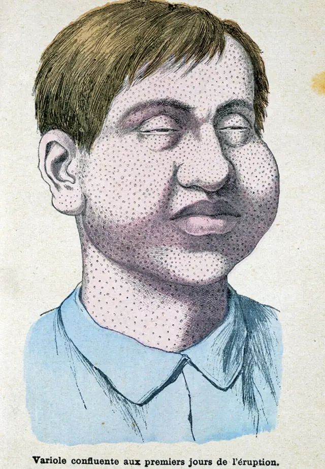 Dibujo mostrando los primeros días de la erupción de viruela en "Les Grands Maux et les Grands Remèdes" Librairie Illustrée - Montgredien & Cie 1889.
