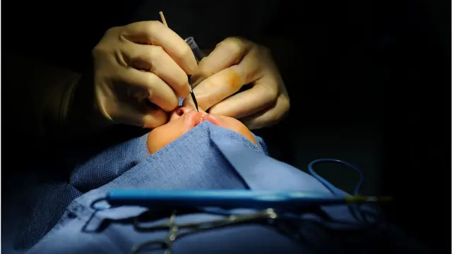 Doctor dey perform surgery on pikin wey get cleft lip