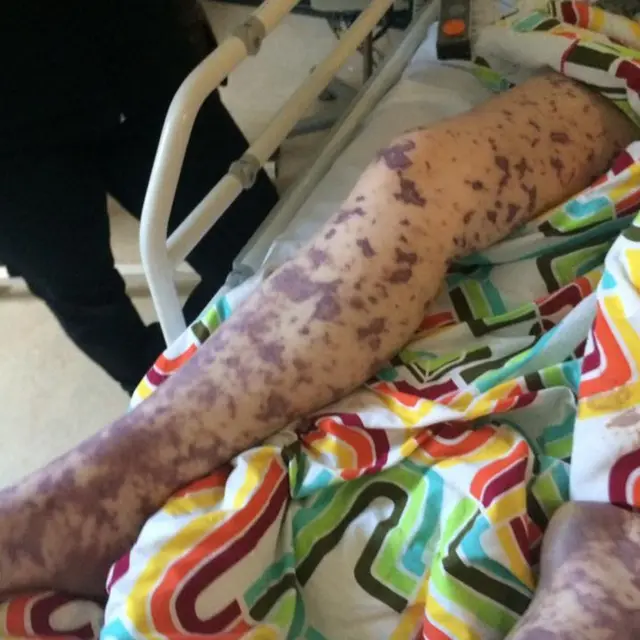 Marcas da doença nas pernas de Charlene