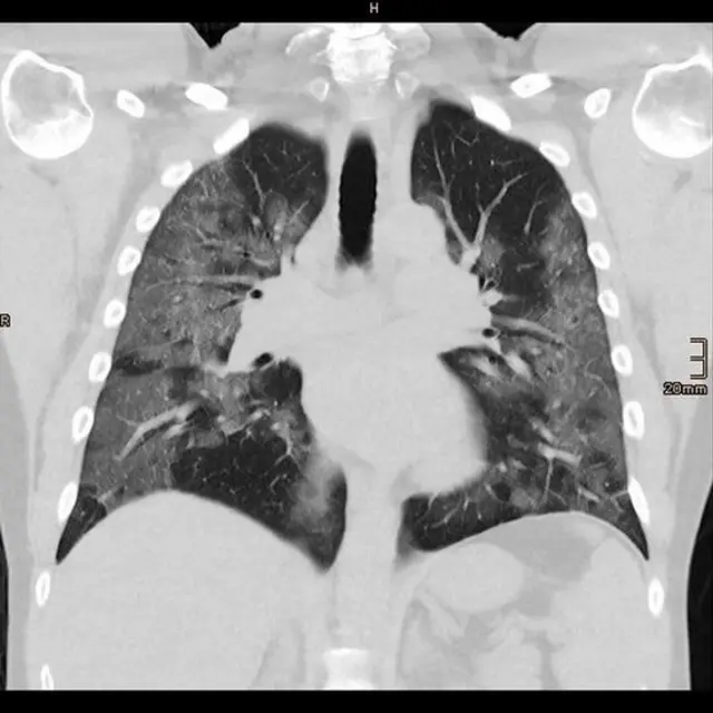 A CT scan picture shows lungs of 48-year-old coronavirus disease (COVID-19) patient