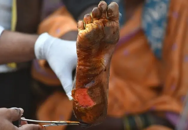 ખેડૂત મહિલાના પગમાં પડેલા છાલાંનો ફોટોગ્રાફ