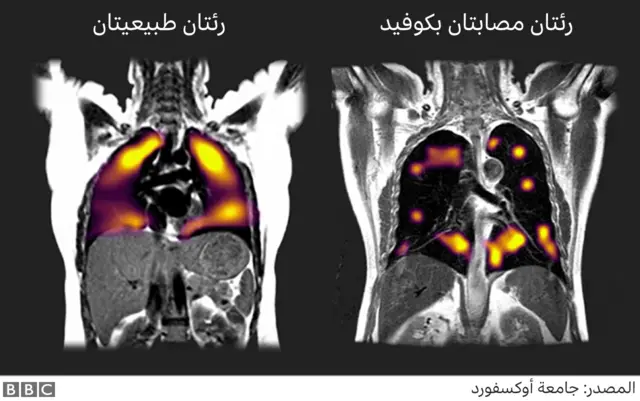 رسم توضيحي لرئتين مصابتين بالفيروس وأخريين سليمتين