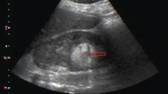 Doctors dey use Ultrasound scan check weda woman don get Fibriod.