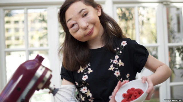 นิกกี คริสตู วัย 13 ปี แชมป์ทำขนมอบรุ่นเยาว์ของสถานีโทรทัศน์ CBBC เป็นผู้ป่วยโรค AVM